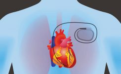 Q: I need a pacemaker. Is this a major surgery?