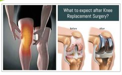 What is Total knee replacement surgery?