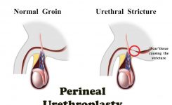 What is Urethroplasty?